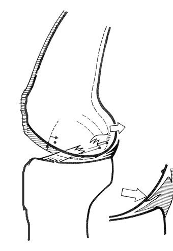 ACL meniscal injury illustration