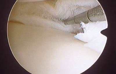 Horizontal meniscal tear view