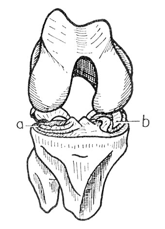Anterior horn detachment illustration