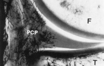 Frontal section of medial knee compartment