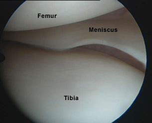 Normal Meniscus on Arthroscopy