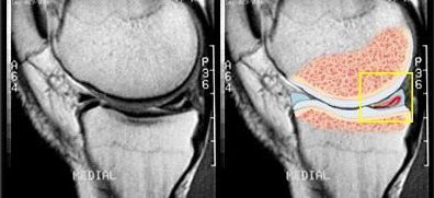 torn meniscus