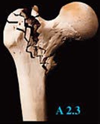 Extracapsular